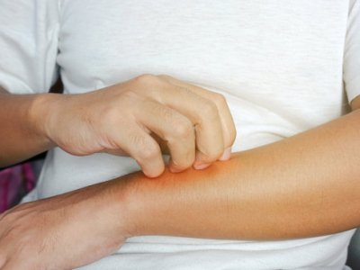 Le Psoriasis
